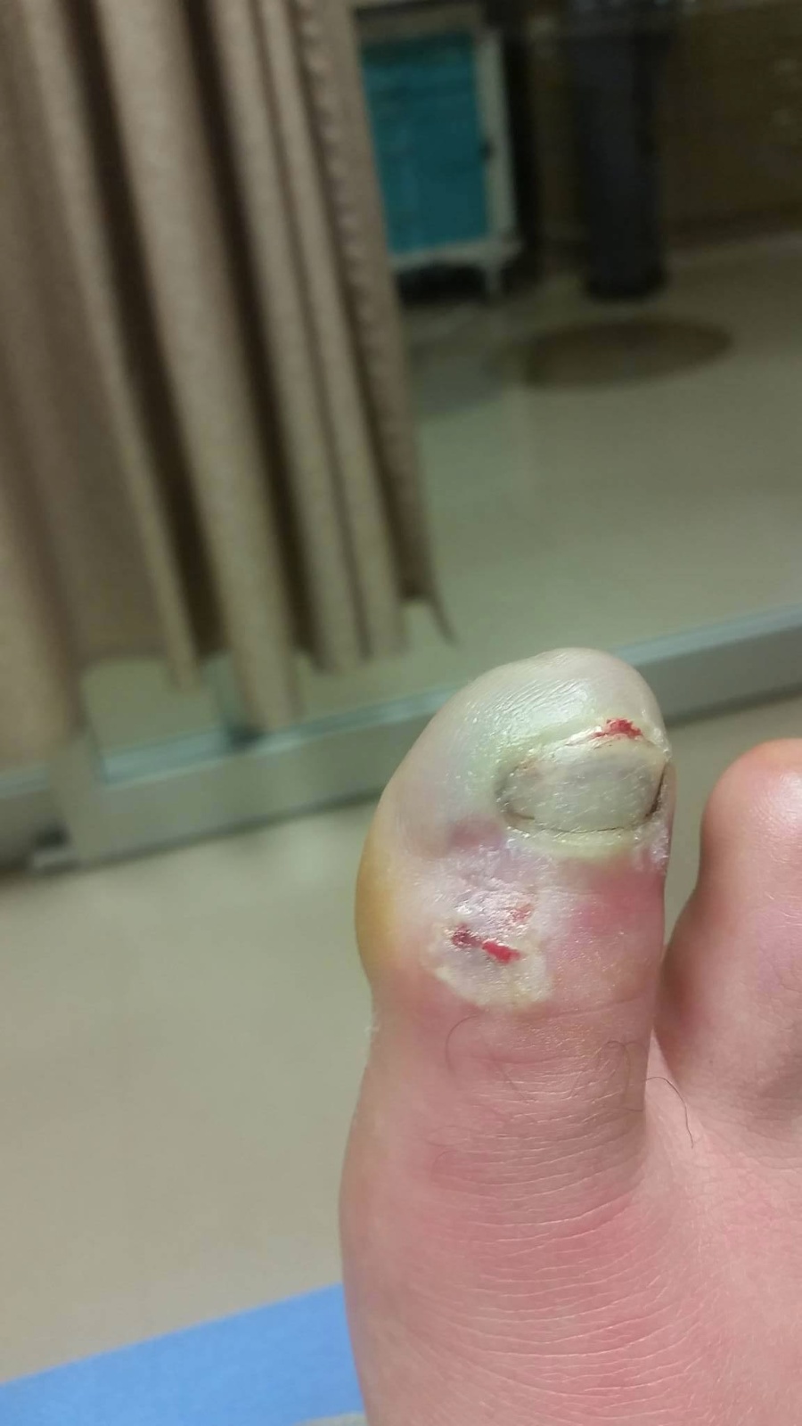Inoue toe 2