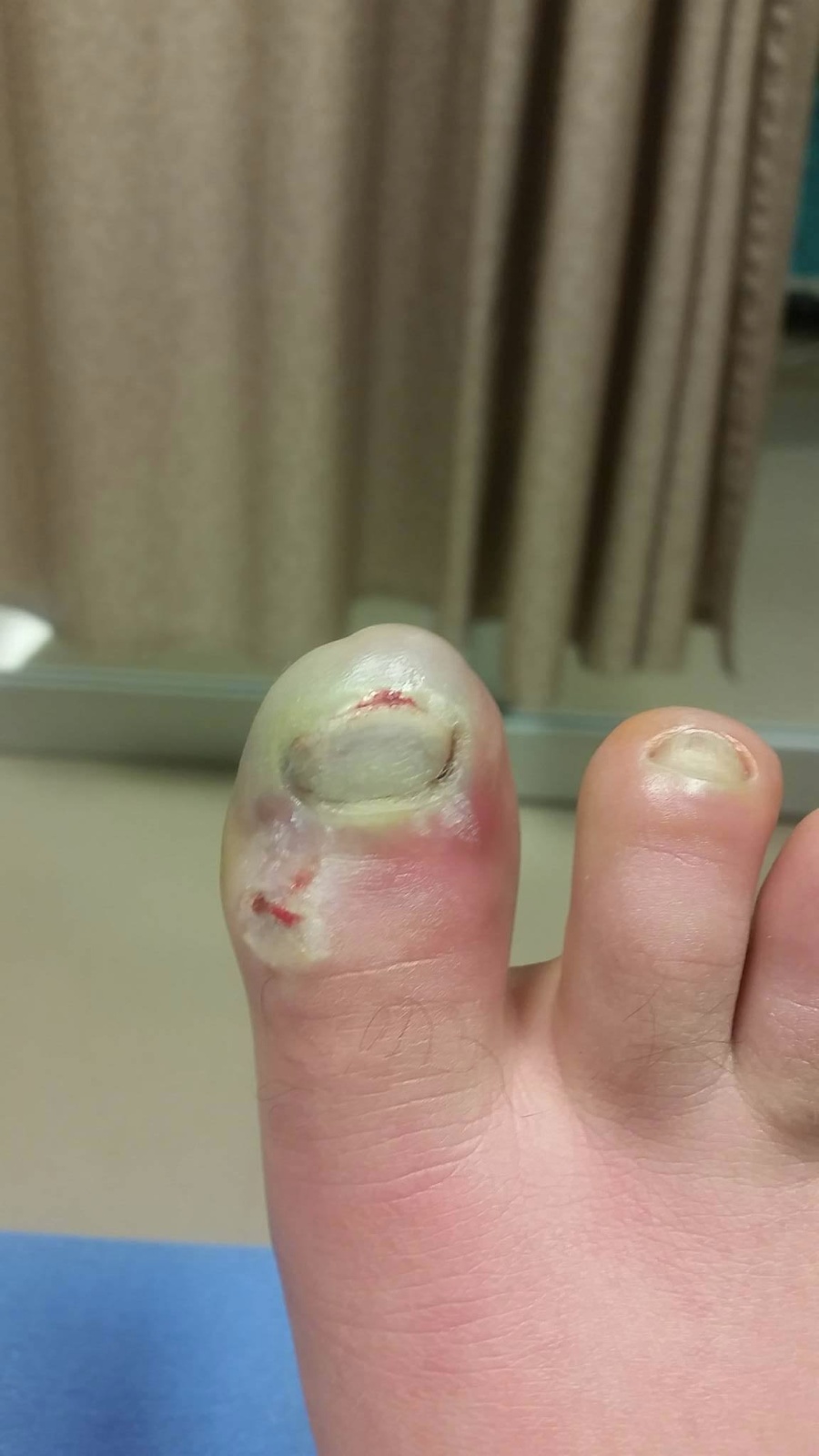 Inoue toe 3