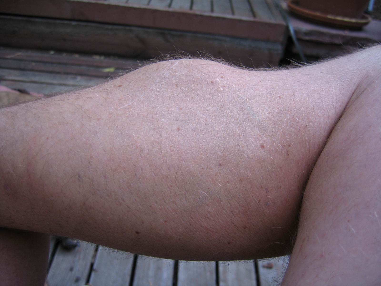 Alex hematoma
