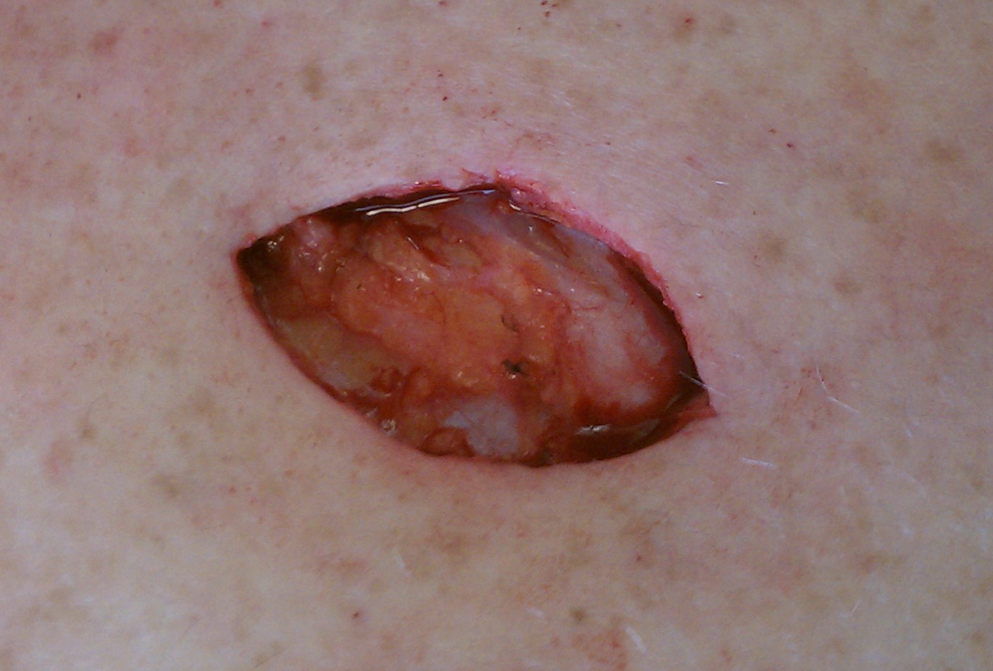 Alex henes mole removal