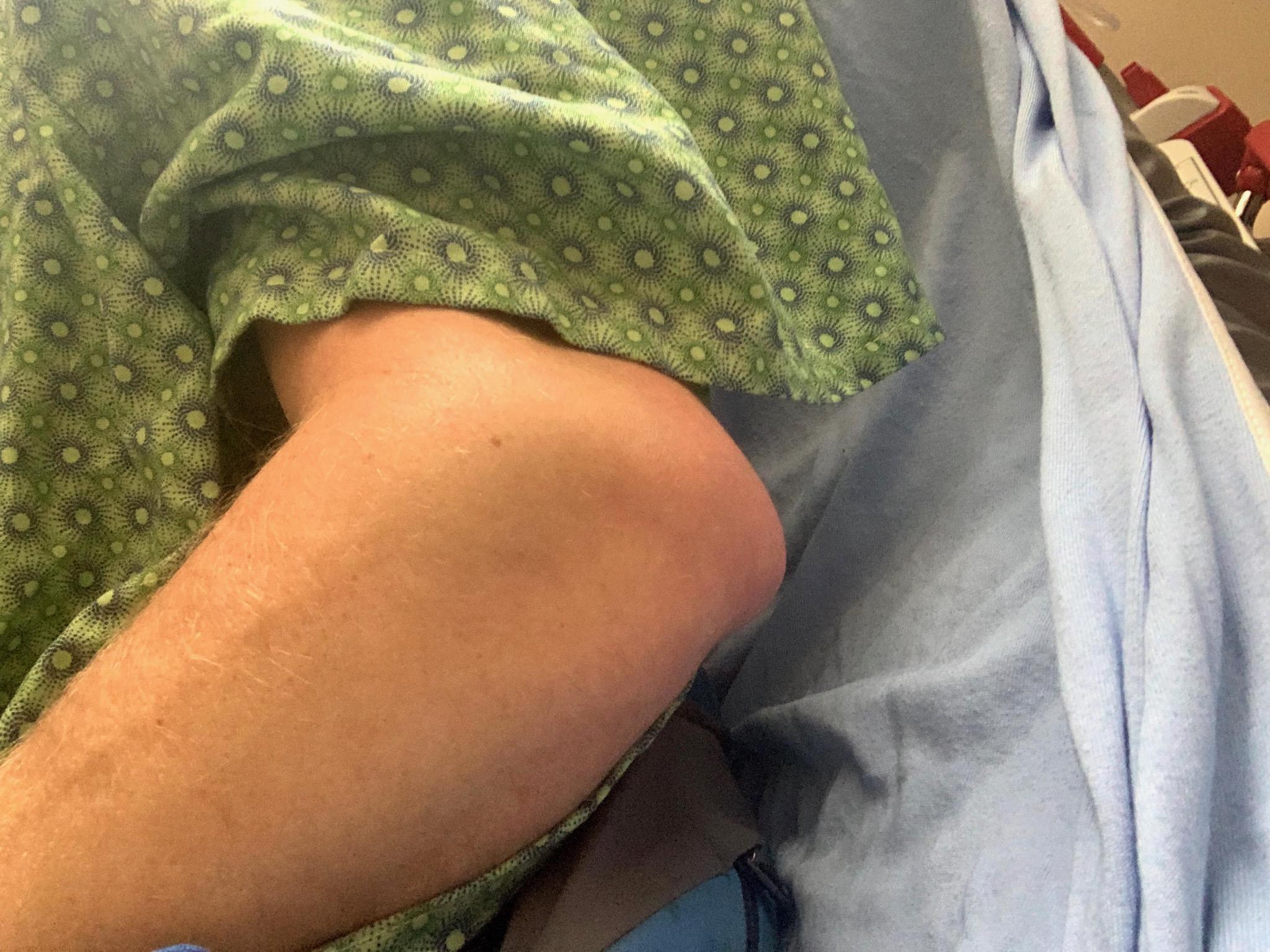 Jeremy miller elbow