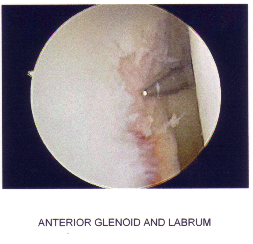 Shoulder09