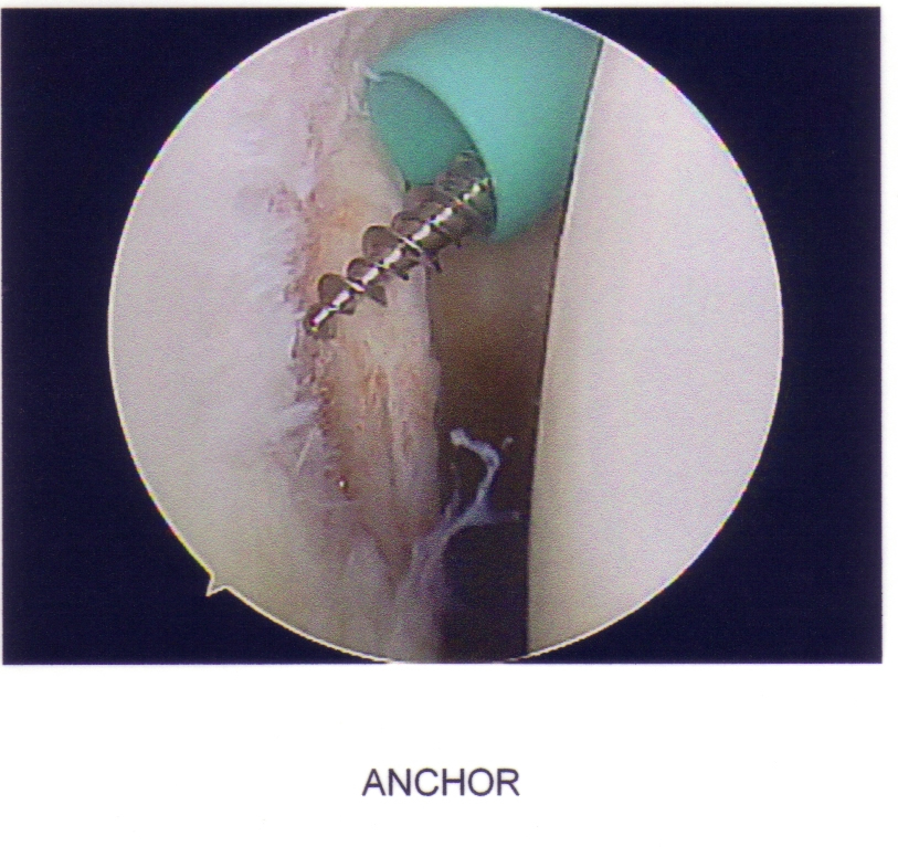 Shoulder13